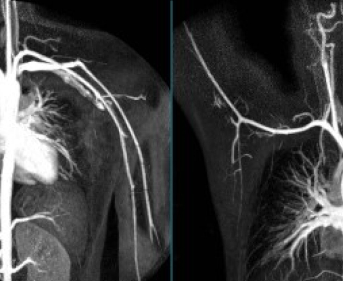 Angiotomografía de cuello y miembros superiores