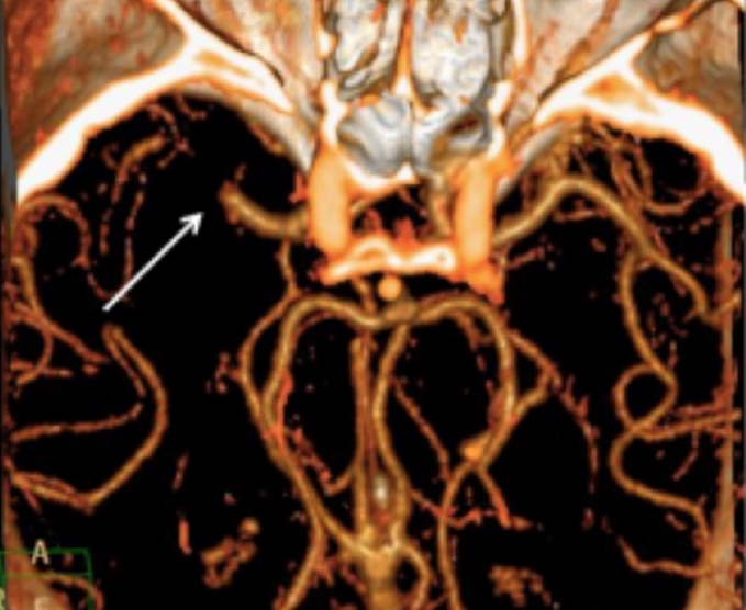 Angiotomografía cerebral