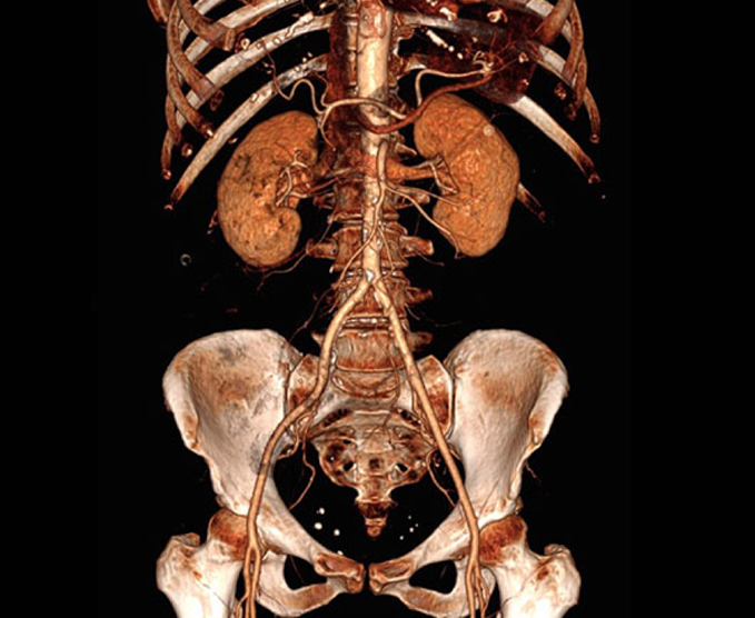 Angiotomografía de aorta abdominal