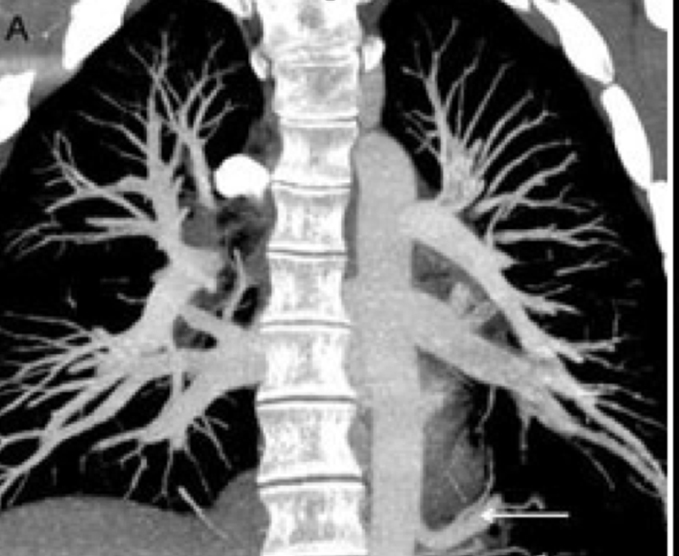 Angiotomografía pulmonar