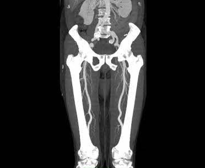 Angiotomografía de miembros inferiores