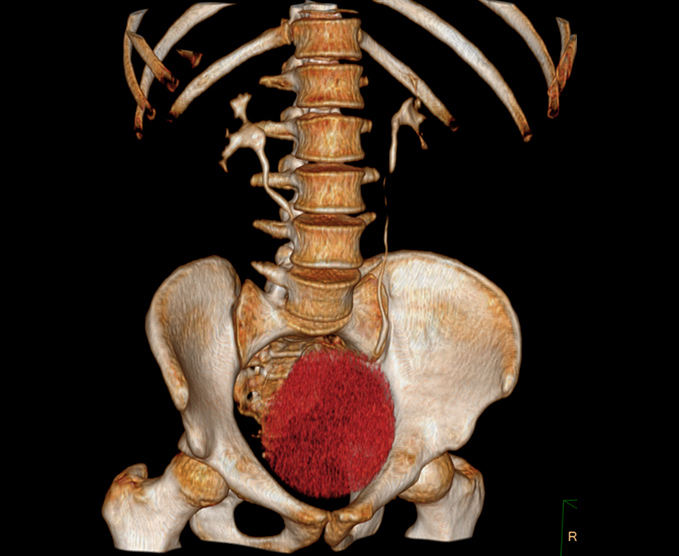 Urotomografía