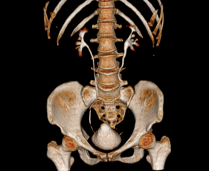 Urotomografía