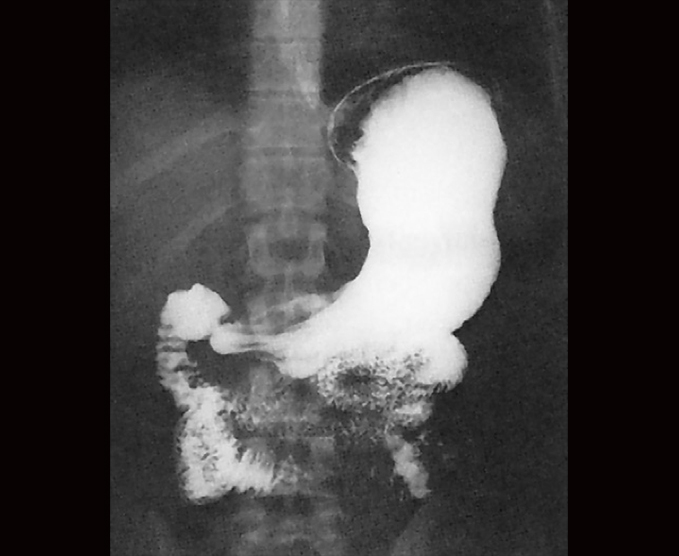 Serie esógafo gastroduodenal