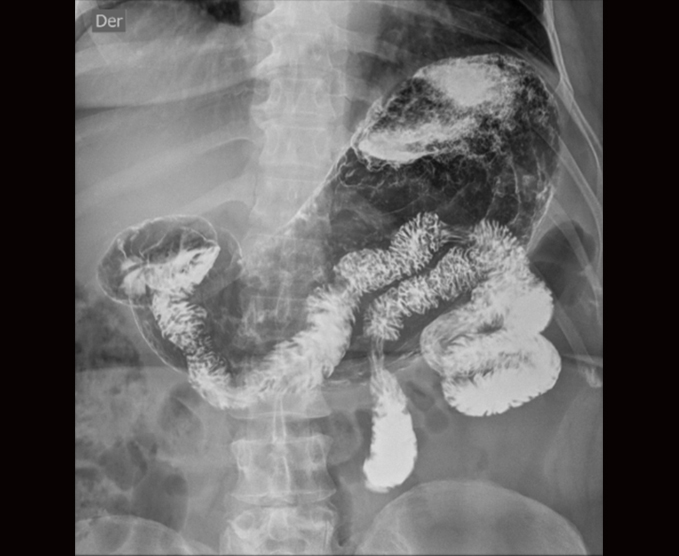 Serie esógafo gastroduodenal