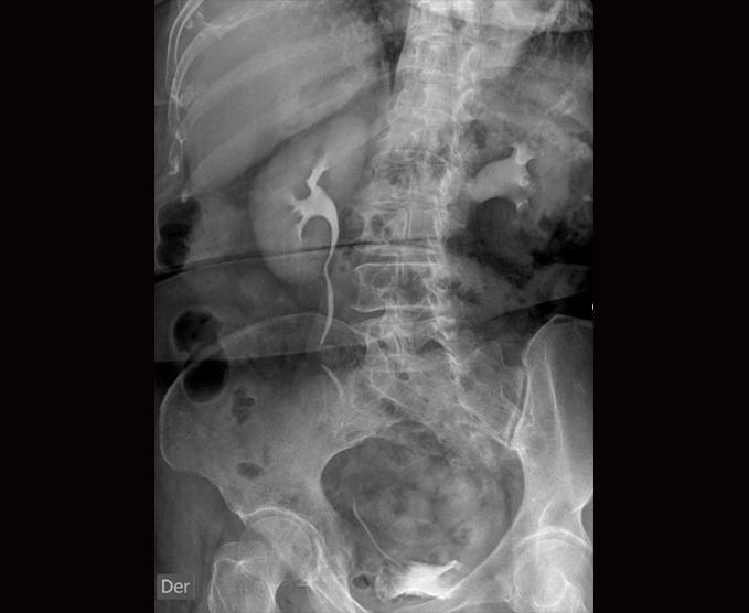 Urografía excretora