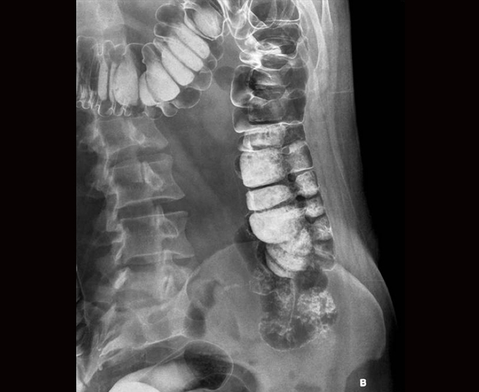 Colon por enema