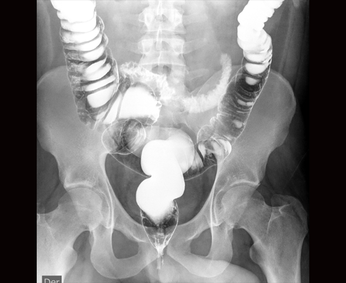 Colon por enema