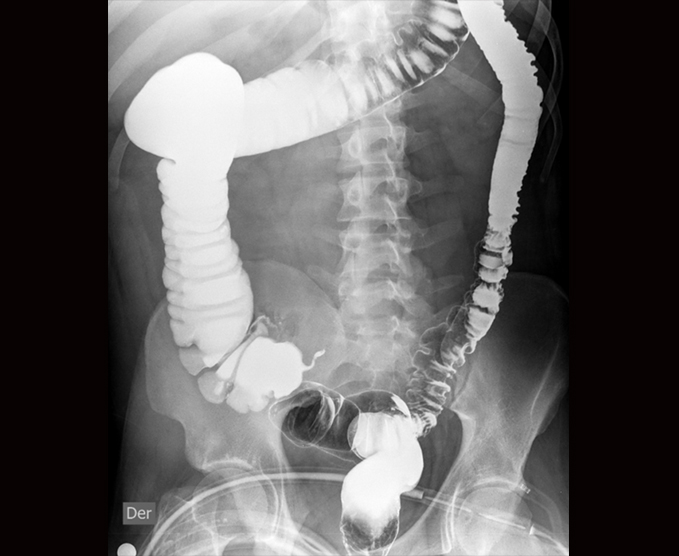 Colon por enema