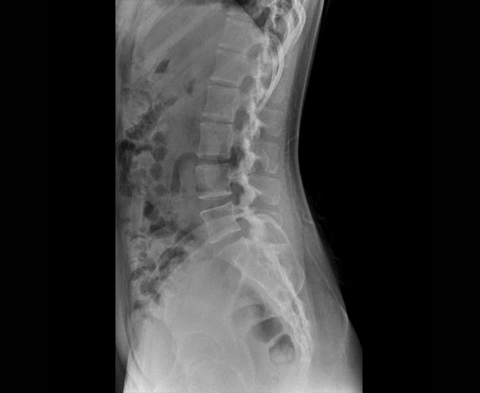 Radiografía de columna