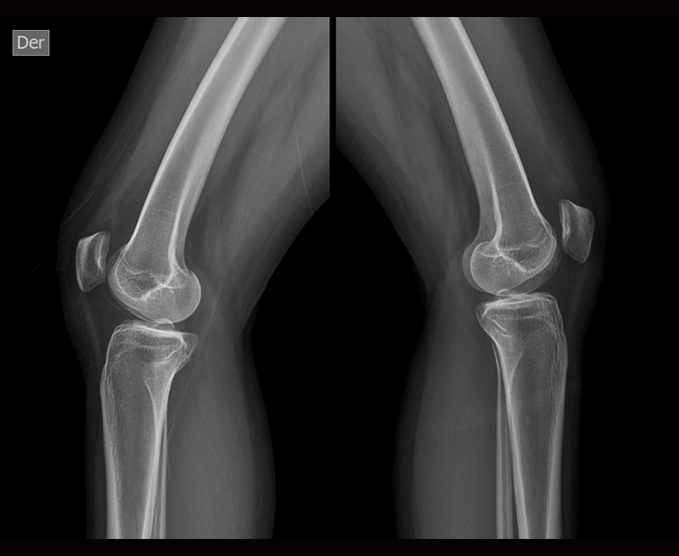 Radiografía de rodillas