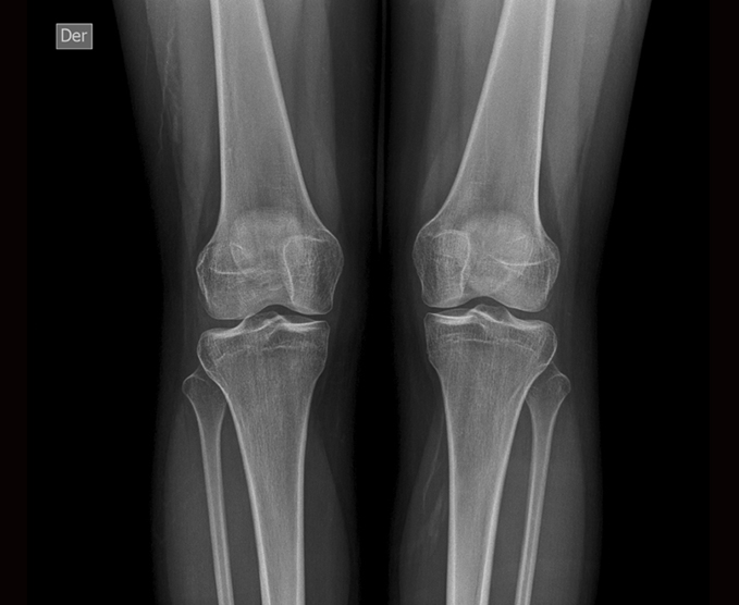 Radiografía de rodillas