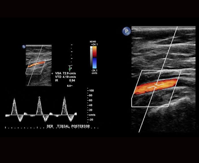 Ultrasonido Doppler