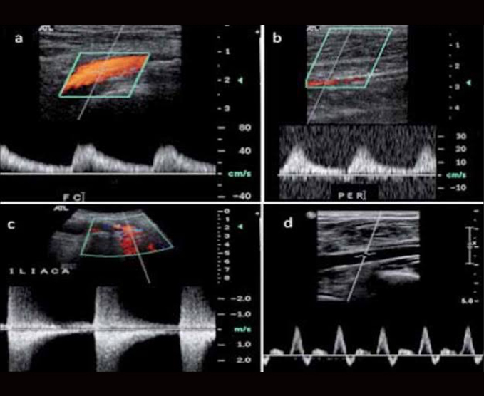 Ultrasonido Doppler