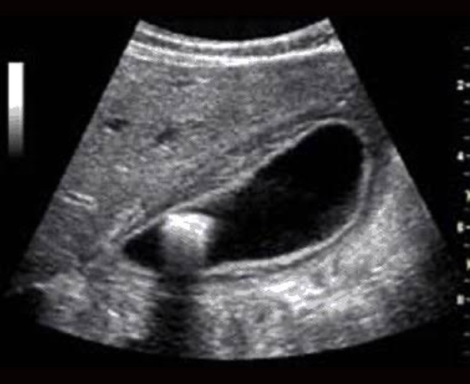 Ultrasonido vesicular