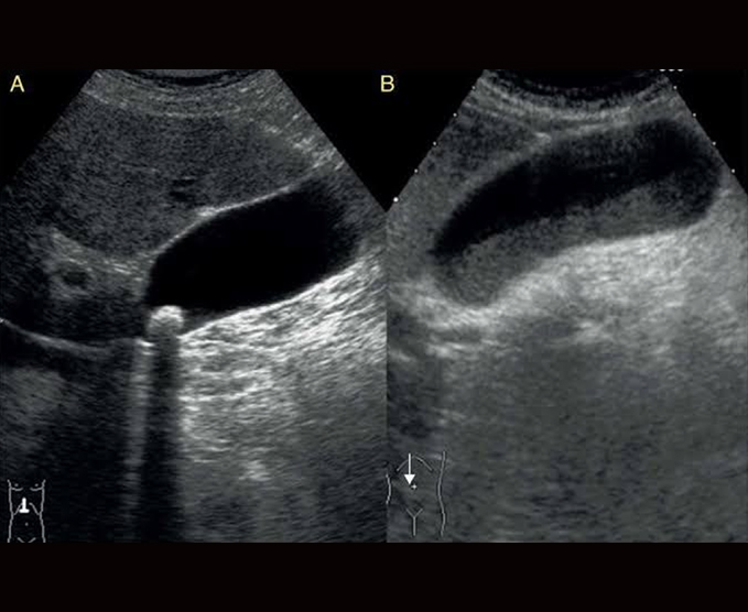 Ultrasonido vesicular